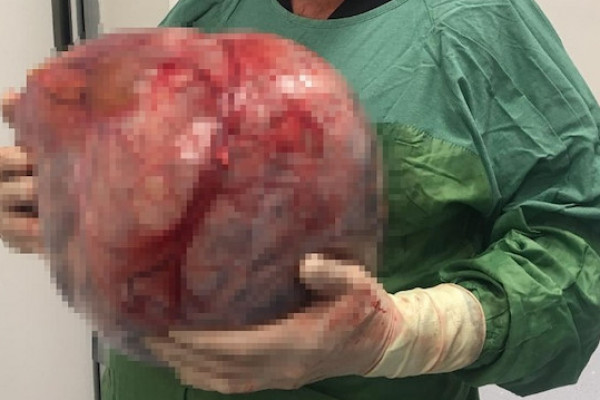 86 yaşlı qadının qarnından 12 kiloqramlıq kista çıxarıldı (Foto)