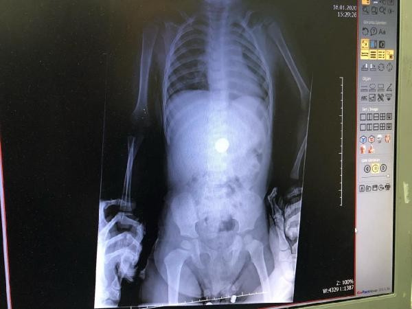 Uşağın dəmir pulu udması rentgen vasitəsilə aşkar edildi - FOTO