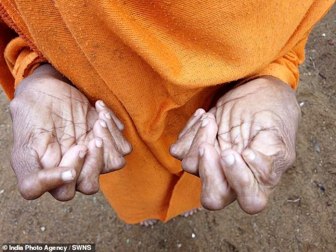 31 barmaqları olan 63 yaşındakı qadına“cadı” elan edildi - FOTOLAR