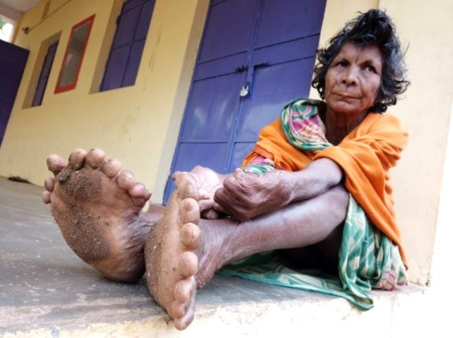 31 barmaqları olan 63 yaşındakı qadına“cadı” elan edildi - FOTOLAR