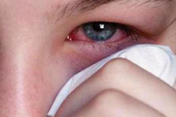 Göz allergiyasının qarşısını almağın   5 YOLU