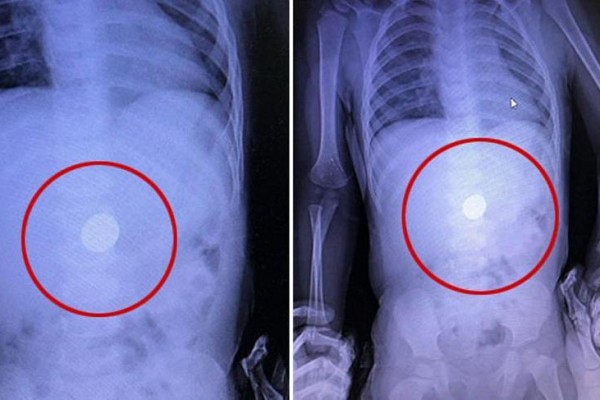 Uşağın dəmir pulu udması rentgen vasitəsilə aşkar edildi - FOTO